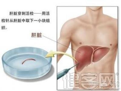 如果確診為甲肝需要注意什麼