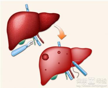 肝炎的早期症狀有哪些？