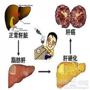 肝硬化患者飲食護理的四項注意