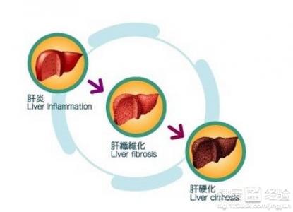 肝硬化常見有哪些致病因素