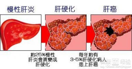 肝硬化患者調理生活