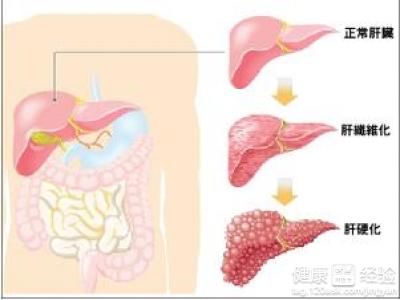 肝硬化對人體會造成什麼危害