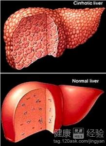 哪一類人患肝硬化的幾率較高