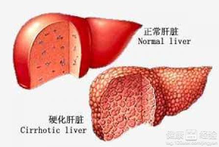 肝硬化要注意什麼