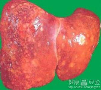 肝硬化肝損傷症狀