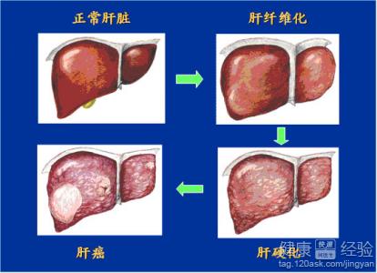 肝硬化治療方法