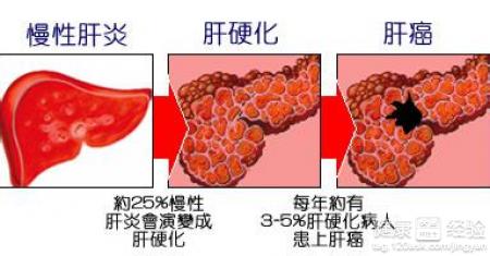 晚期肝硬化能活多久