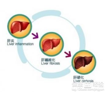 肝硬化後內分泌嚴重失調是怎麼回事