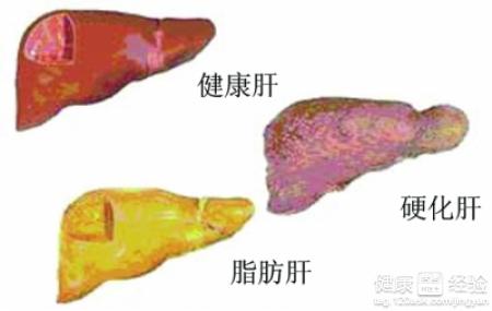 肝硬化需要做哪些檢查的