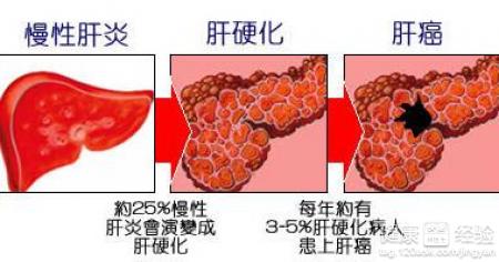 肝硬化腹水高燒不退怎麼辦