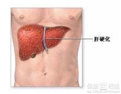 肝硬化患者該如何科學用藥