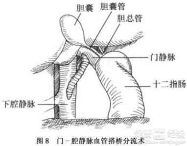 得了門脈高壓怎麼辦