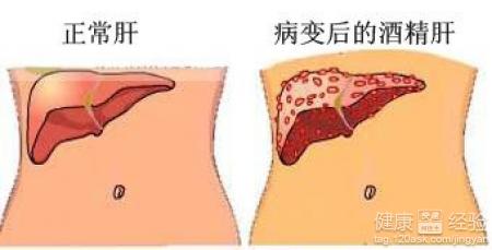 酒精肝停止飲酒能自動恢復嗎