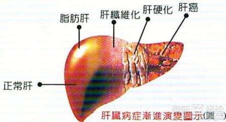 乙肝，脂肪肝，酒精肝是不是一樣的