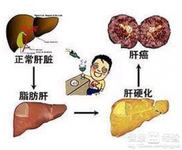 得了酒精肝該怎麼治療