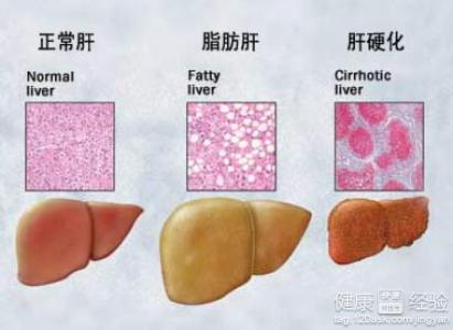 脂肪肝的飲食注意什麼