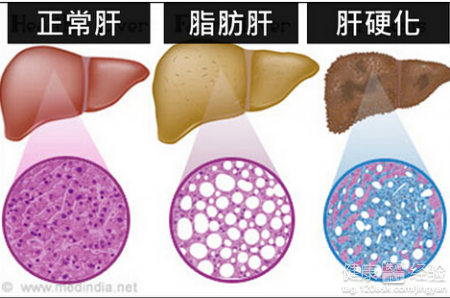 脂肪肝的治療保健大全