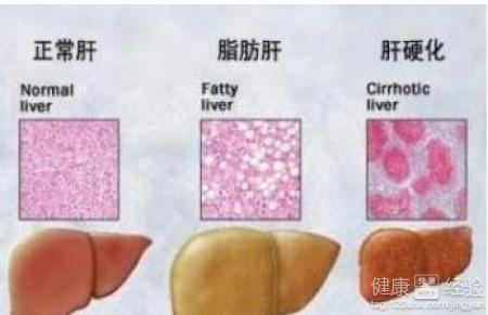不同群體的脂肪肝是怎樣引起的
