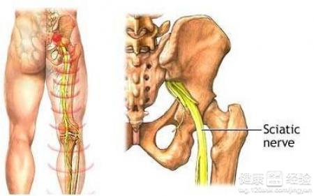 坐骨神經和脂肪肝有沒有關系