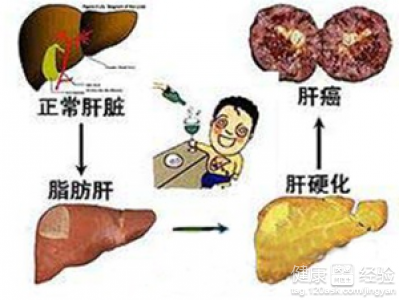 脂肪肝有什麼感覺