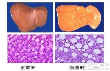 怎樣預防脂肪肝有效呢？