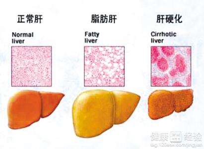 脂肪肝患者平時應注意什麼