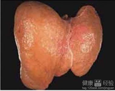 肝脾腫大脂肪肝怎麼治療