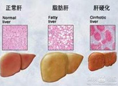 輕度的脂肪肝有沒有症狀呢