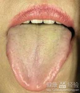 大三陽患者舌苔發黃是怎麼回事呢？