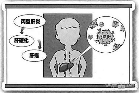 丙肝患者不能使用干擾素該怎樣進行抗病毒治療