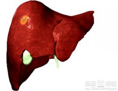 肝囊腫需要注意什麼