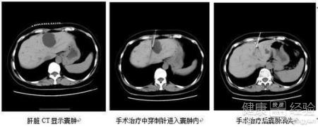 什麼中藥治療肝囊腫