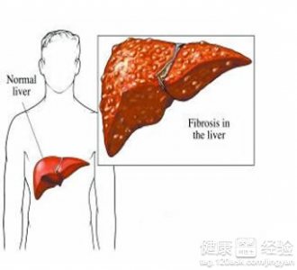 肝囊腫是怎麼形成