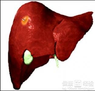 肝囊腫什麼原因造成的