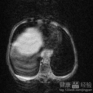 體檢說是肝囊腫怎麼辦