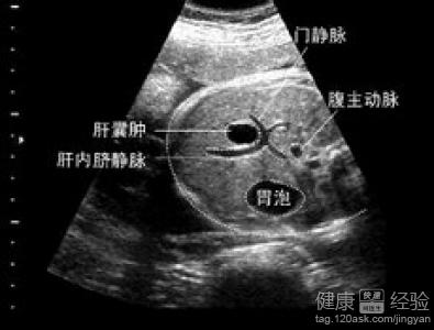 肝囊腫怎樣調理