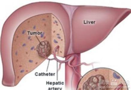 肝囊腫是怎麼回事吃點什麼