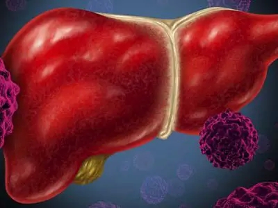 肝囊腫有哪些臨床表現和症狀？