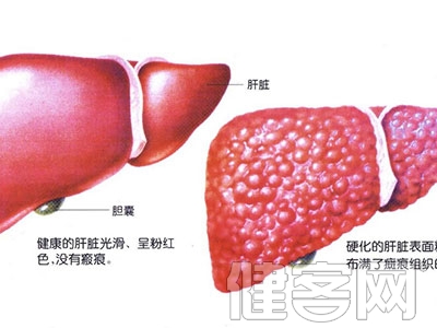 肝囊腫是怎麼形成的 肝囊腫的分類