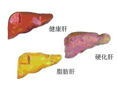 看看肝腹水怎麼產生的 出現並發症易導致死亡