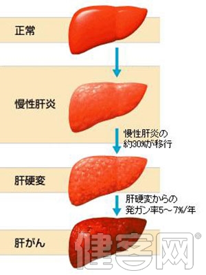 肝硬化患者如何應對肝腹水惡化