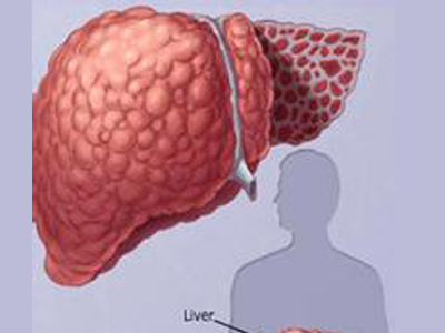 肝纖維化是怎麼導致的 治療前要當心哪些事情
