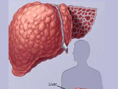 肝纖維化有這三個症狀