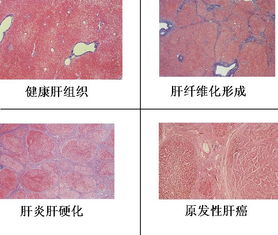 肝纖維化怎麼治療效果好