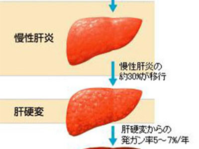 肝脾腫大是肝癌的體征之一