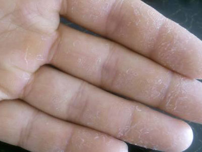 肝硬化與手掌干燥有直接關系嗎
