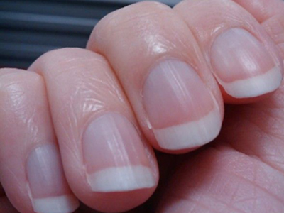 早期肝病與指甲的關系