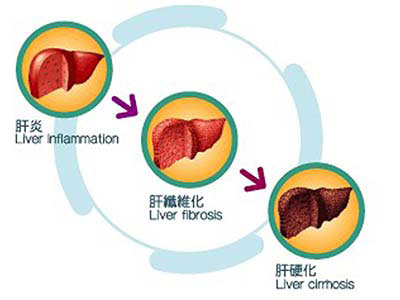 如何預防肝炎後肝硬化傳染？