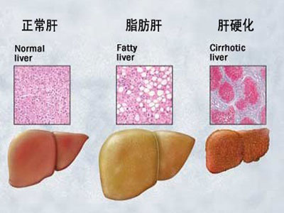 脂肪肝疾病的危害多