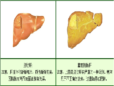 脂肪肝的危害都體現在哪些方面？